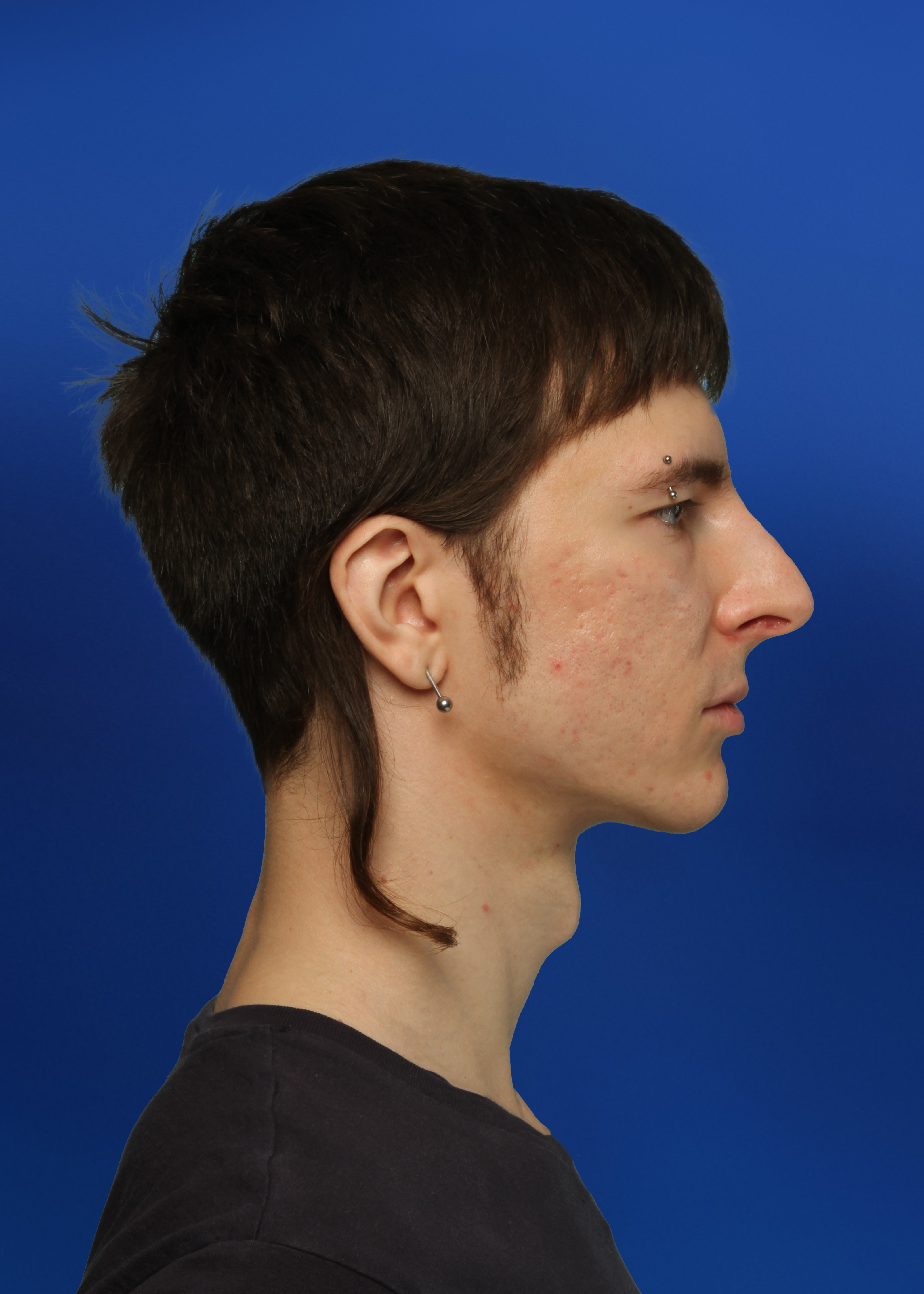 After Rhinoplasty - Front View